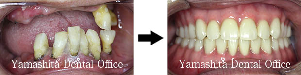 BPS総入れ歯症例1