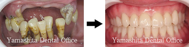 BPS総入れ歯症例2