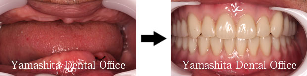 BPS総入れ歯症例3