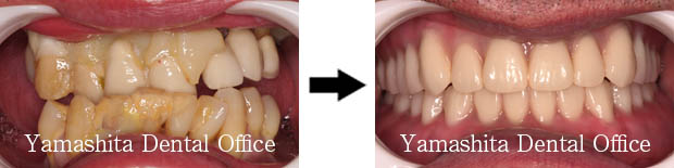 BPS総入れ歯症例5