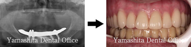 BPS総入れ歯症例6