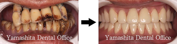 BPS総入れ歯症例7