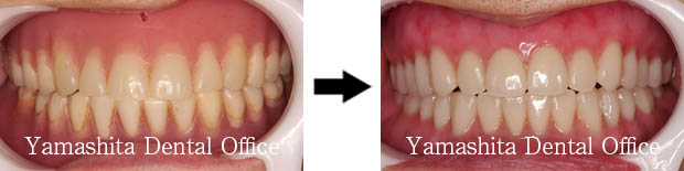 BPS総入れ歯症例8