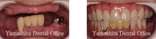 BPS総入れ歯症例3