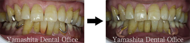BPS部分入れ歯症例1
