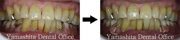 クラスプのエステティック加工比較ケース