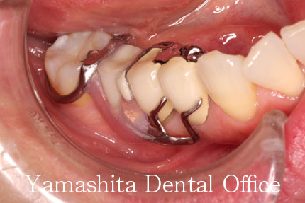 部分入れ歯症例2