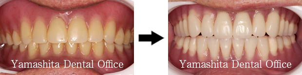 BPS総入れ歯症例5