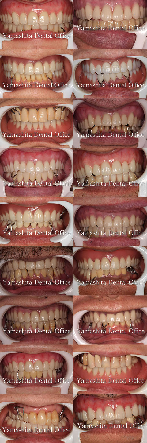 総入れ歯・部分入れ歯サンプル