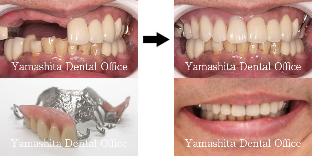 審美入れ歯症例1