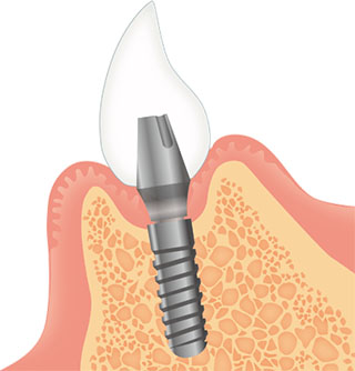 インプラントの人工の歯
