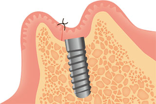 インプラントのネジ