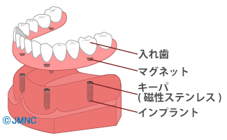 入れ歯タイプ