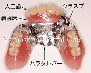 上の部分入れ歯