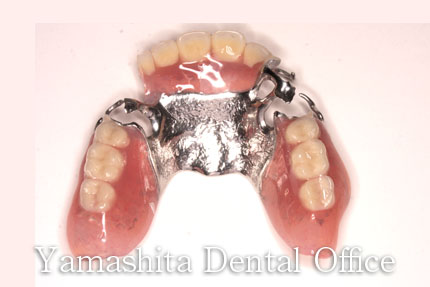 修理前の部分入れ歯