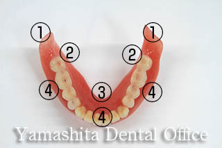 下顎吸着入れ歯の形