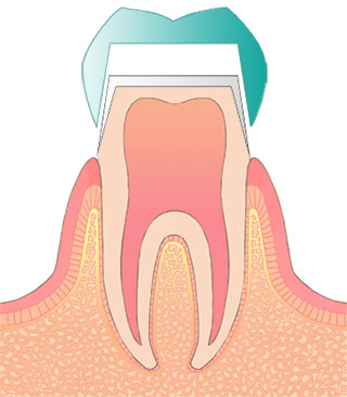 テレスコープ義歯
