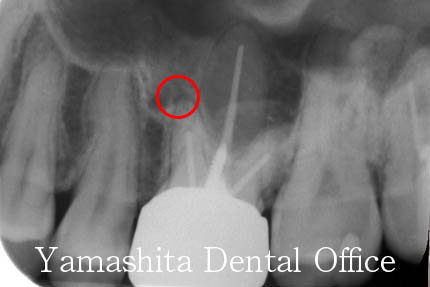 根の治療症例1