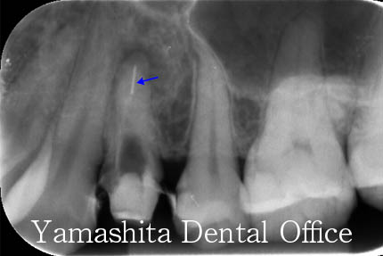 根の治療症例2