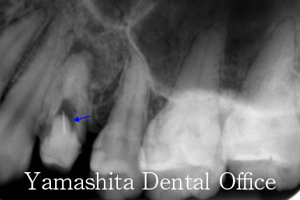根の治療症例2