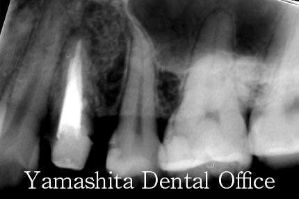 根の治療症例3