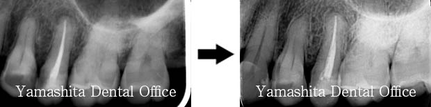 根の治療症例4