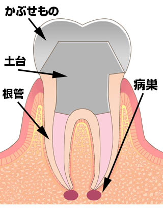 抜髄後歯の構造