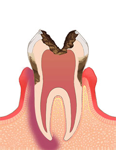 歯内歯周疾患