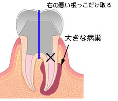 ヘミセクション大阪 | 外科的歯内療法なら山下歯科