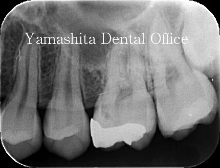 MTA直接覆髄術前レントゲン写真