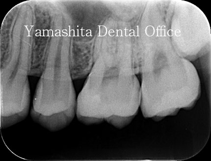 MTA直接覆髄術後レントゲン写真