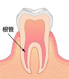 根管