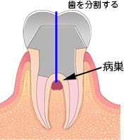 歯根分割
