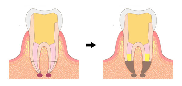 根尖切除術大阪 | 根尖切除術なら山下歯科