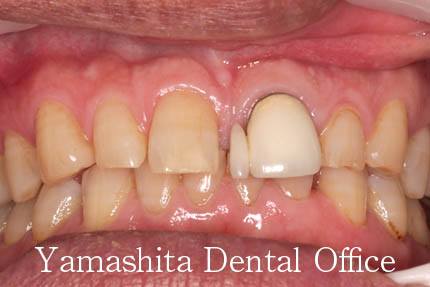 前歯部審美障害治療症例