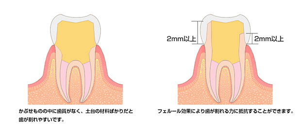 エキストルージョン