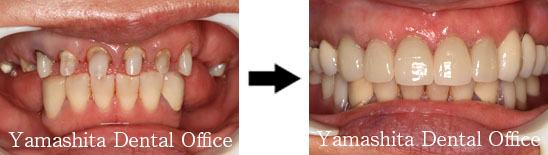 オールセラミッククラウン症例