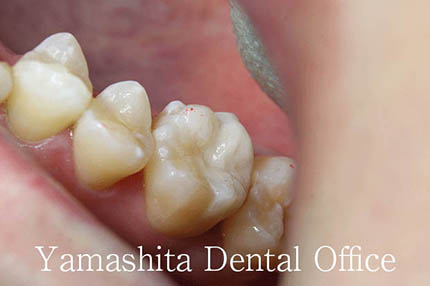 ダイレクトボンディング症例1