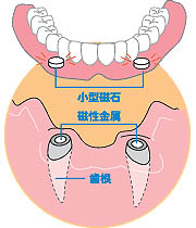 磁性アタッチメント義歯